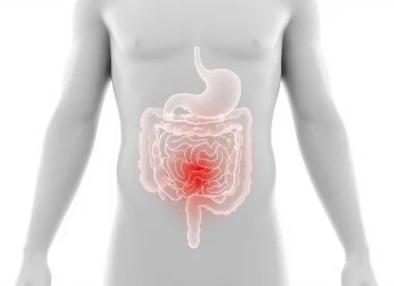Schéma médical du système digestif montrant l’intestin en rouge pour illustrer l’inflammation douloureuse typique de la maladie de Crohn.